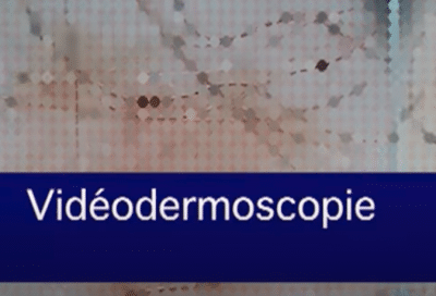 Vidéo-Dermatoscopie