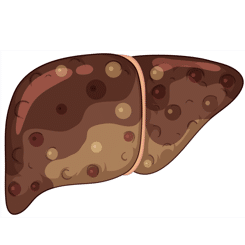 Score Fibrosis-4